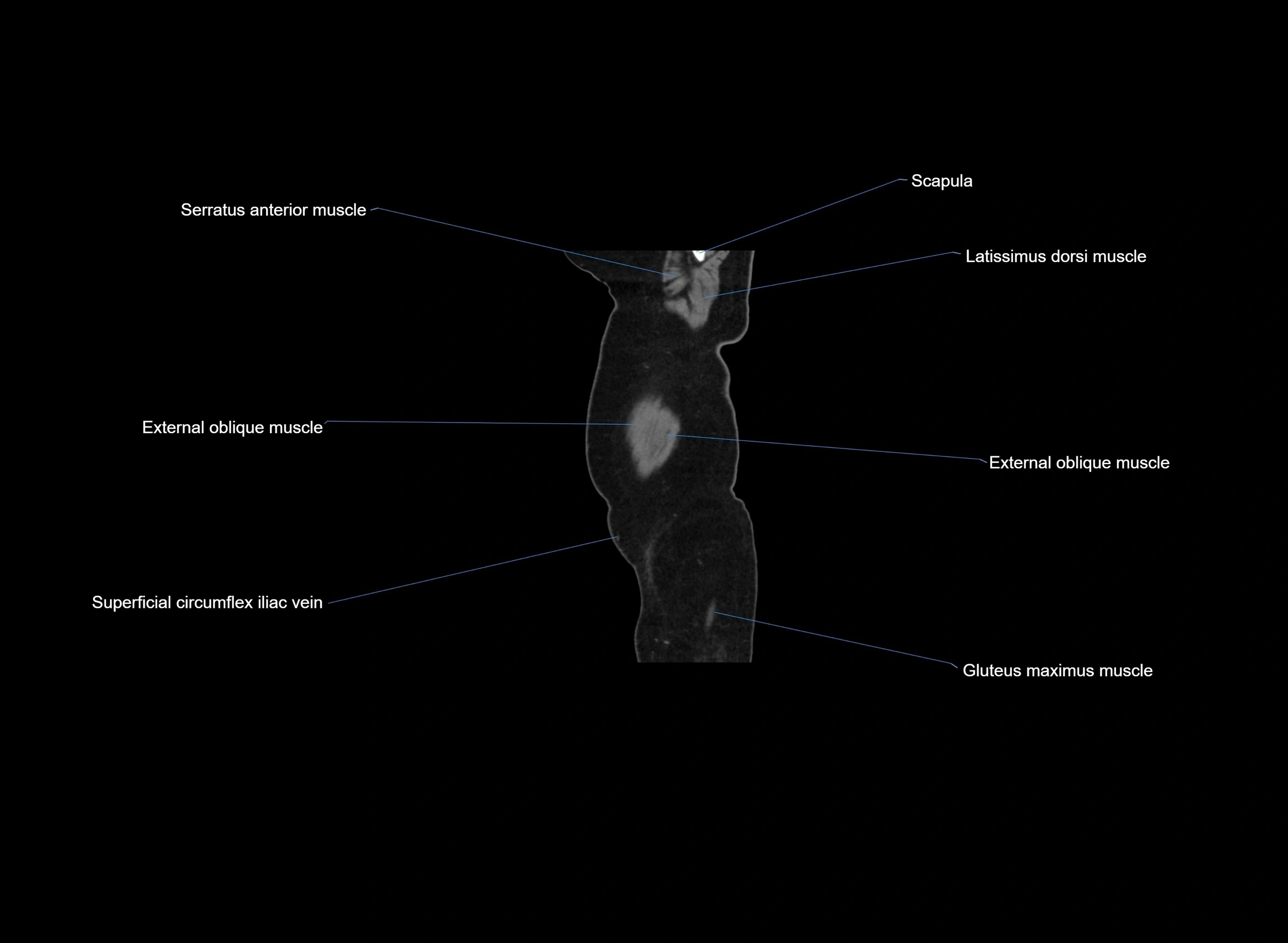 CT Abdomen sagittal cross sectional anatomy labelled radiology image -00109.webp